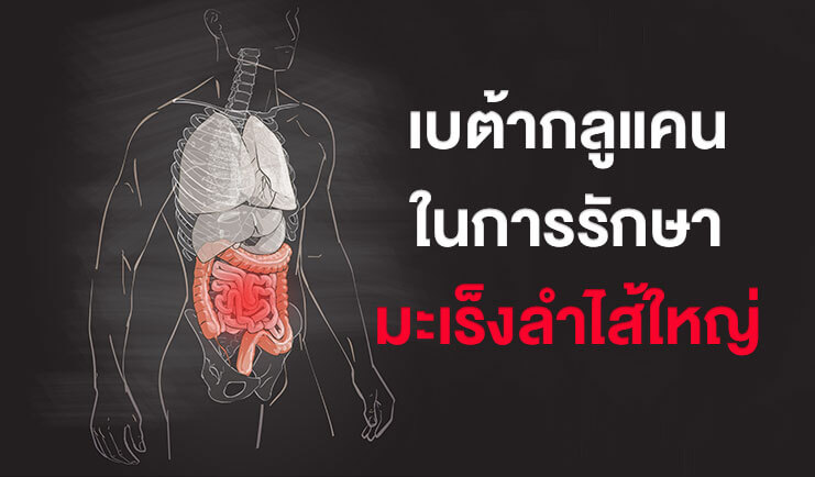 โรคมะเร็งลำไส้ใหญ่